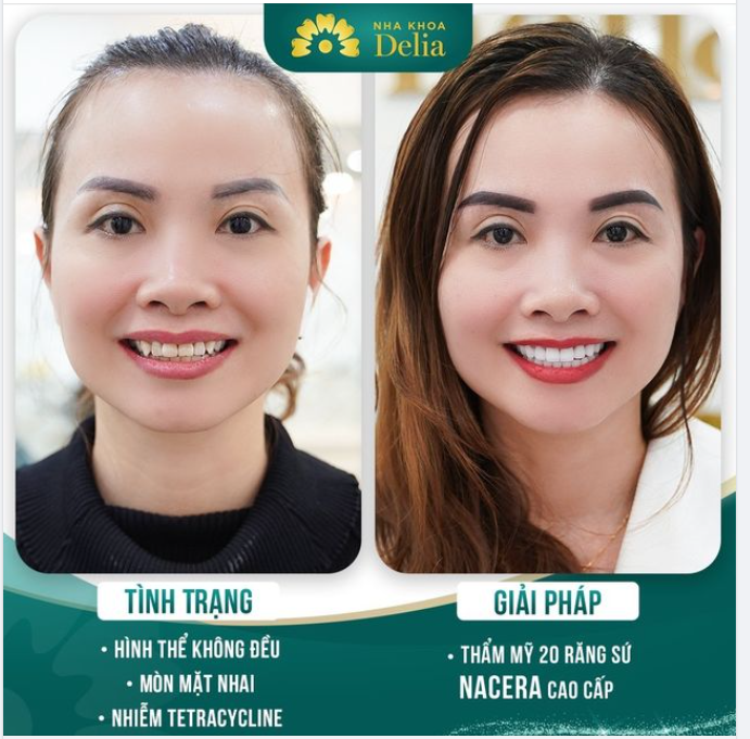 Chị Châu mong muốn cải thiện màu sắc răng trắng sáng mà không ảnh hưởng sức khoẻ răng miệng.