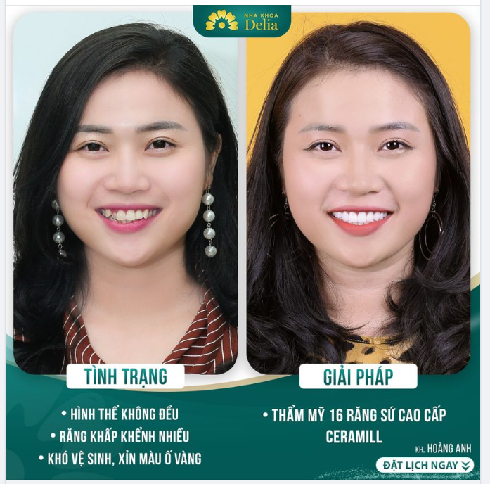 Chị Hoàng Anh chia sẻ với Delia mong muốn cải thiện màu sắc răng và ngăn ngừa tình trạng chảy máu chân răng.