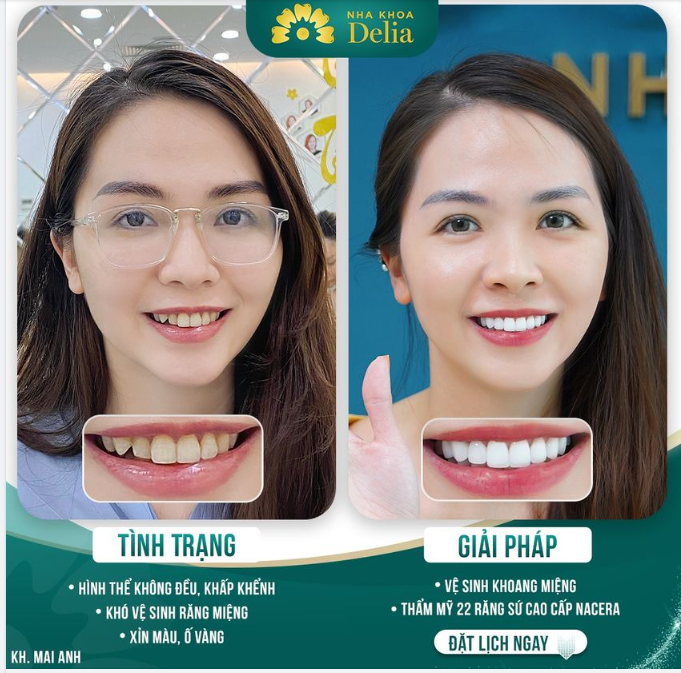 Chị Mai Anh chia sẻ lý do chọn Delia: "Sau khi tìm hiểu kỹ, mình ưng Delia vì màu sắc và dáng răng rất tự nhiên. Làm răng xong thì mình ăn đồ chua thoải mái, thậm chí còn ăn nhiều hơn cả trước!"