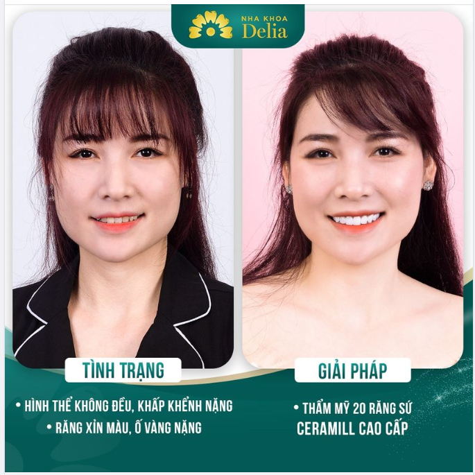Chị Thu Huyền gặp tình trạng: Hình thể không đều, khấp khểnh nhiều, màu răng ố vàng khiến chị không tự tin trong giao tiếp.