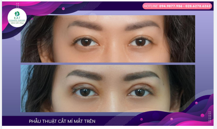 Chỉ với 30 phút phẫu thuật KAT đã giúp bạn tạm biệt đôi mắt không đều, sụp mí và trao lại một đôi mắt hai mí long lanh biết nói.