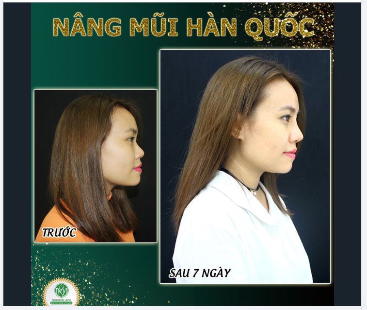 CHIẾC MŨI CHẤT LƯỢNG CAO SAU 7 NGÀY