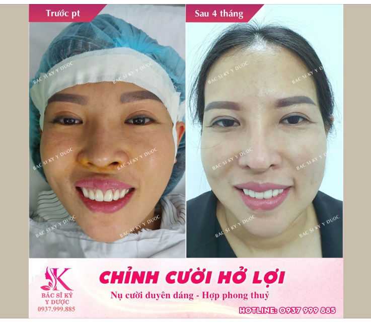 CHỈNH CƯỜI HỞ LỢI - TẠO NỤ CƯỜI DUYÊN DÁNG
