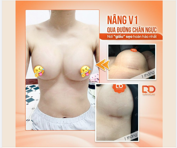 CHỌN NƠI GIẤU SẸO HOÀN HẢO NHẤT KHI THỰC HIỆN NÂNG V1
