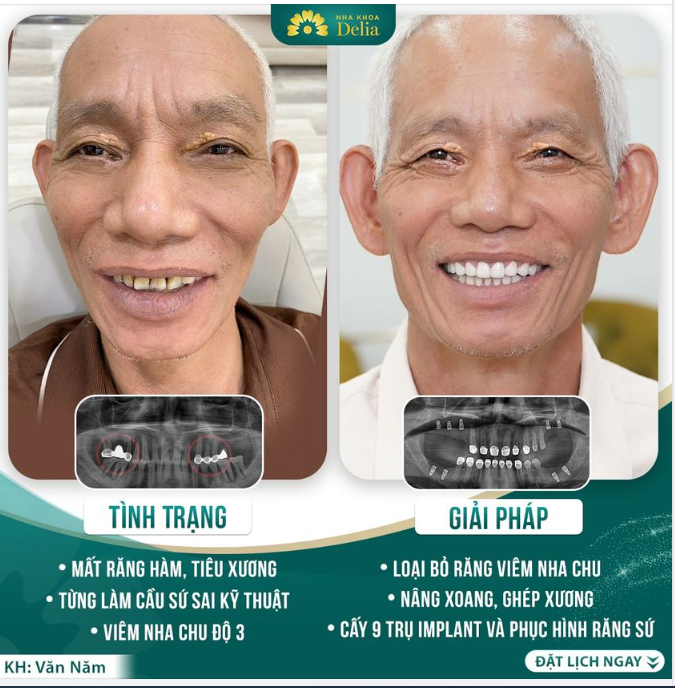 Chú Văn Năm nói với Delia tình trạng răng miệng, khiến chú gặp khó khăn trong ăn nhai, thường xuyên đau nhức cả hàm