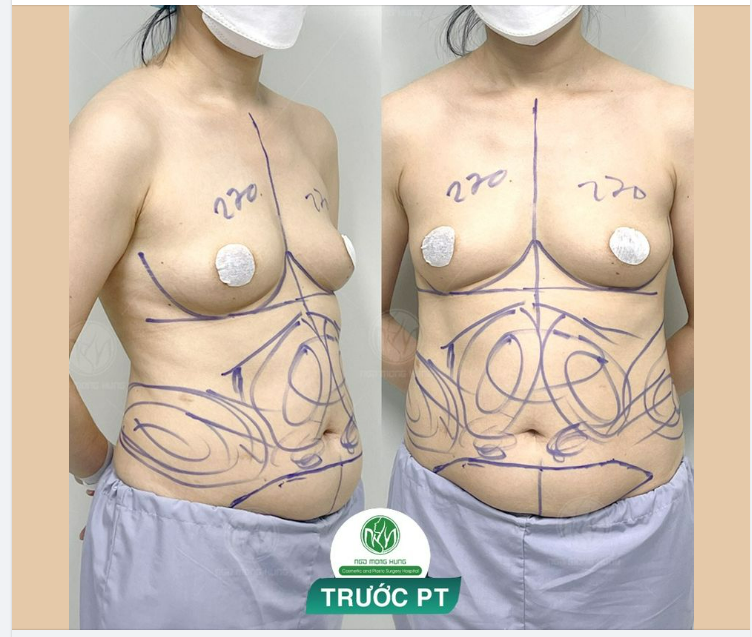 CHUẨN BỊ CHO CA ĐẠI PHẪU NÂNG CẤP VÓC DÁNG