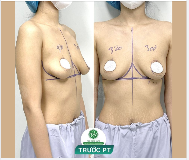 CHUẨN BỊ CHO CA NÂNG NGỰC TREO THU QUẦNG V.Ú