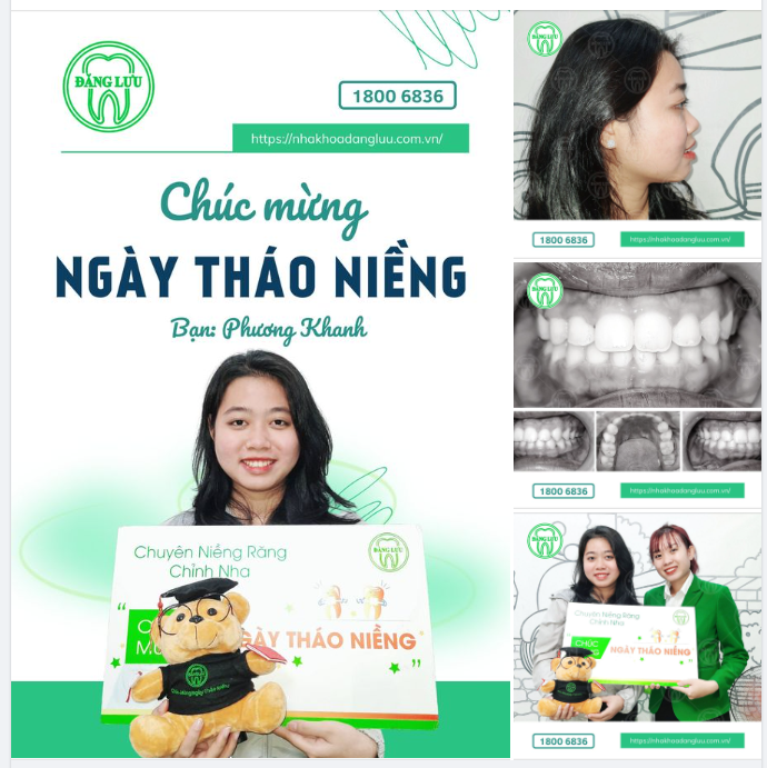 Chúc mừng bạn Phương Khanh đã Niềng răng thành công tại Nha Khoa Đăng Lưu