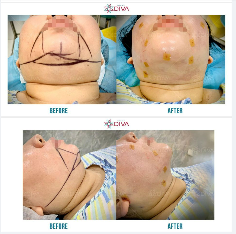 CÓ BAO NHIÊU CÁCH GIẢM MỠ NỌNG CẰM