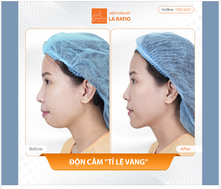 Cô gái bị chê KO CẰM ngày đó. Giờ đã CÓ CẰM chuẩn tỉ lệ vàng rồi!!