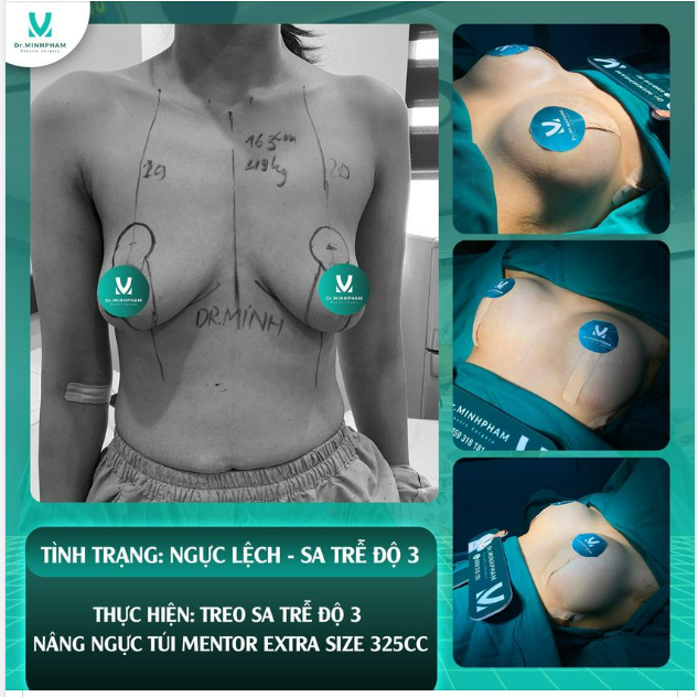 Cơ hội lấy lại tự tin cho người bị sa trễ, phì đại