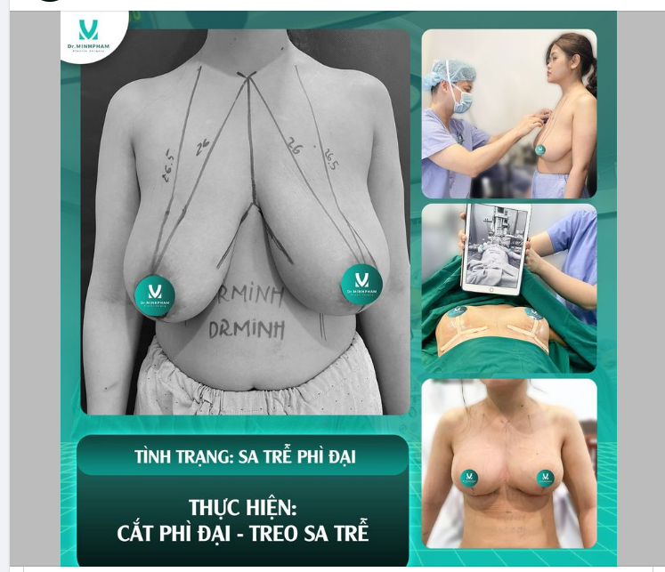Cơ hội lấy lại tự tin cho người bị sa trễ, phì đại