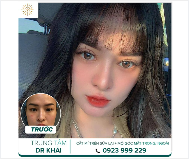CÔ NÀNG thực hiện full combo SỬA LẠI NẾP MÍ VÀ MỞ GÓC MẮT TRONGNGOÀI SAU 3 TUẦN TẠI TRUNG TÂM bs Đỗ Quang Khải