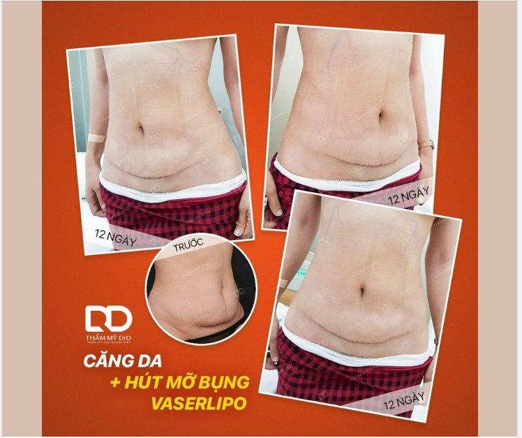CÓ NÊN CHỈ THỰC HIỆN HÚT MỠ ĐƠN THUẦN