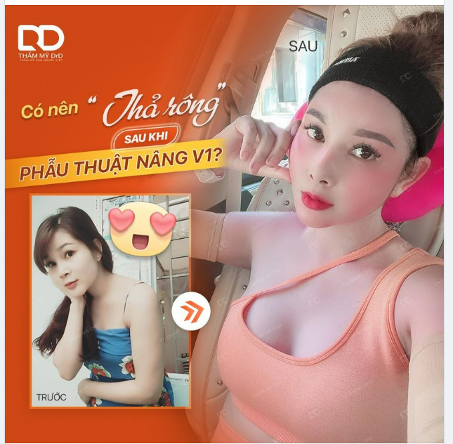 CÓ NÊN THẢ RÔNG NGỰC SAU PHẪU THUẬT NÂNG V1
