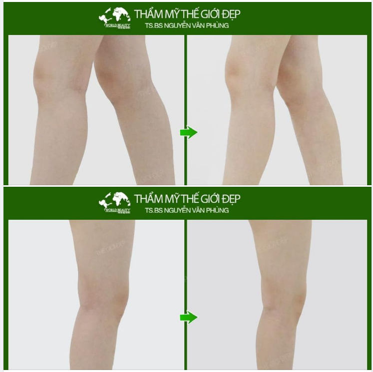 Có ngay đôi chân thon, thẳng tắp chỉ với phẫu thuật hút mỡ bắp chân bằng công nghệ Body-Jet-Evo.