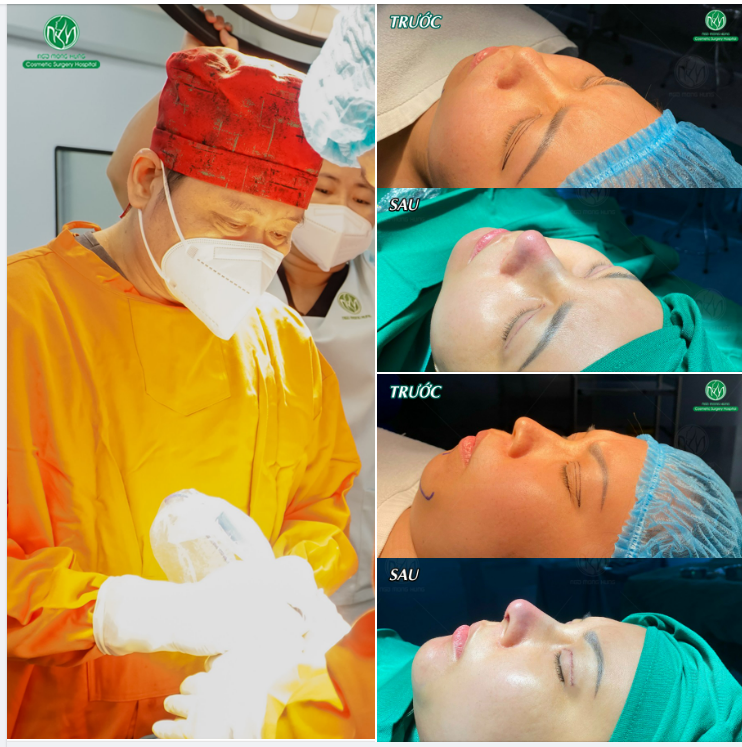 COMBO 3 DỊCH VỤ NÂNG MŨI + CẮT MÍ + ĐỘN CẰM