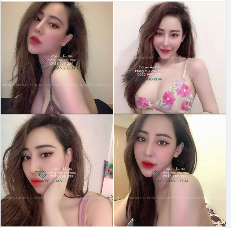 Combo Mũi mí bên trung tâm bs Đỗ Quang Khải luôn được khách hàng lựa chọn thay đổi toàn diện cho gương mặt.