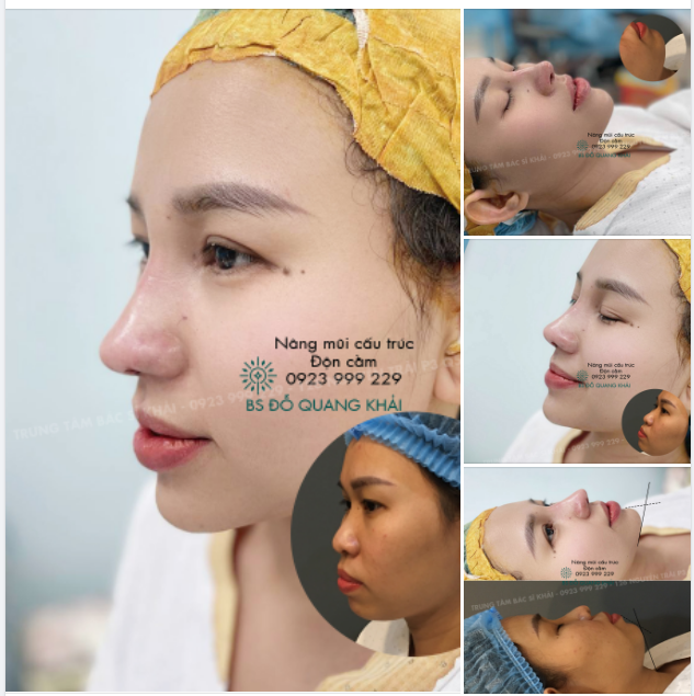COMBO NÂNG MŨI ĐỘN CẰM SỤN MỸ KHÁCH MONG MUỐN CẢI THIỆN 100% VẺ ĐẸP GƯƠNG MẶT
