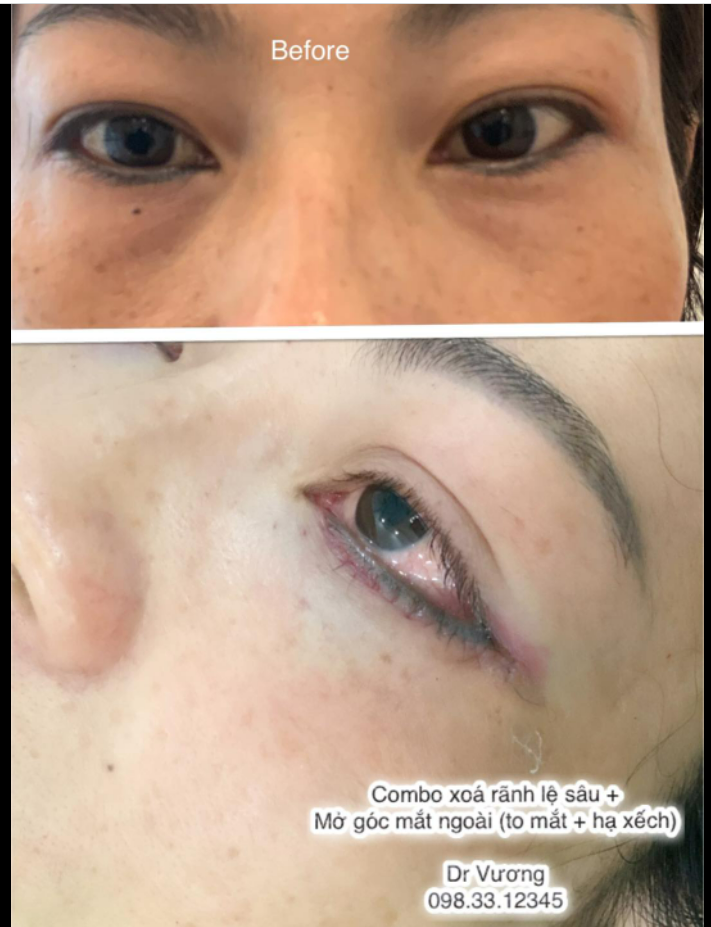 Combo xoá rãnh lệ sâu mở góc mắt ngoài cho bạn gái từ Bạc Liêu