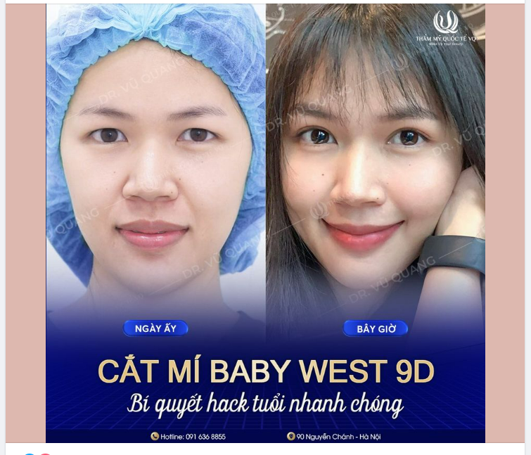 Cùng bạn xinh tươi mỗi ngày với Cắt mí Baby West 9D tại Thẩm mỹ quốc tế VQ.