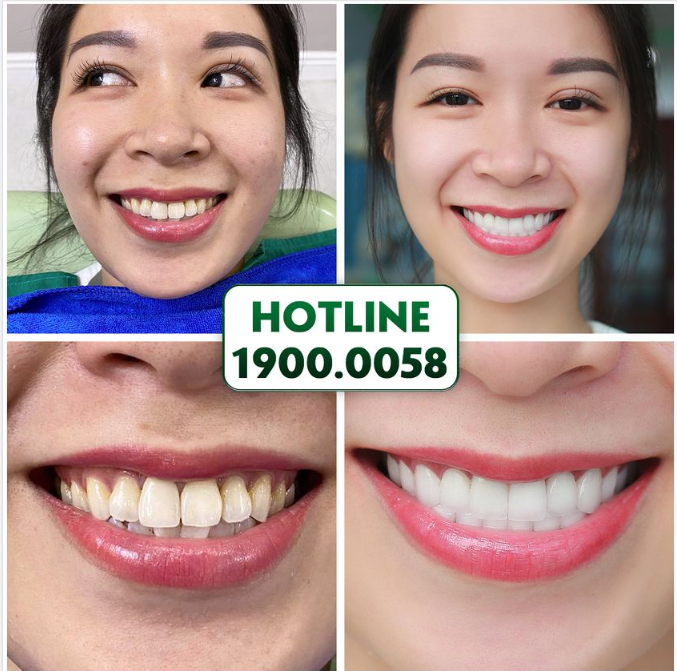 CUNG RĂNG ĐẸP NHƯ Ý - TỰ TIN KHOE SẮC HƯƠNG