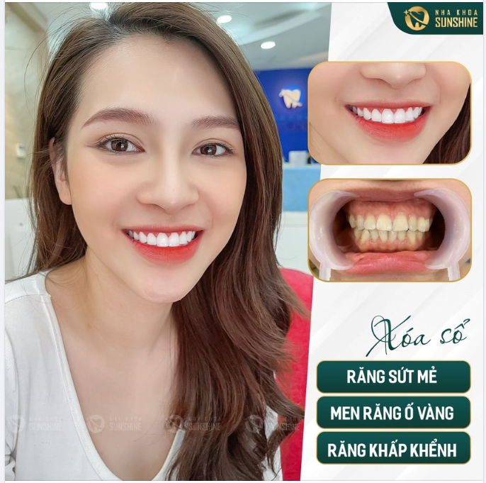 Cùng Sunshine hiện thực hoá giấc mơ sở hữu nụ cười đẹp duyên dáng