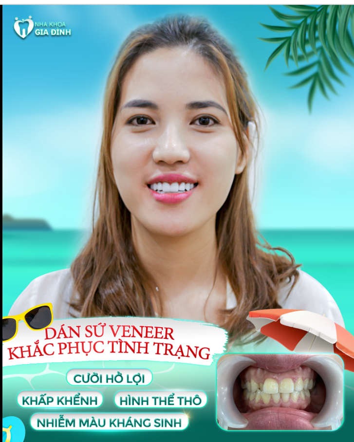 CƯỜI HỞ LỢI MÀ CHƯA BIẾT KHẮC PHỤC SAO