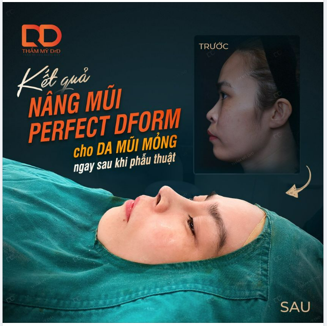 DA MŨI MỎNG CÓ NÂNG MŨI ĐƯỢC KHÔNG