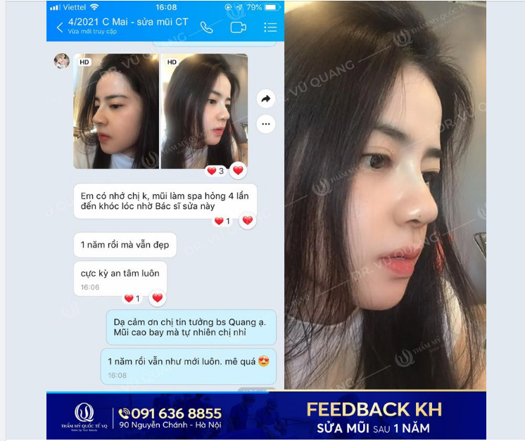 Đã nâng mũi, không ai muốn phải sửa đi sửa lại nhiều lần.