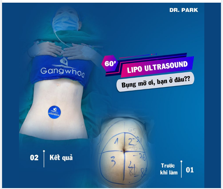 ĐÃ TỪNG GIẢM MỠ THẤT BẠI - VÌ BẠN CHƯA BIẾT ĐẾN LIPO ULTRASOUND