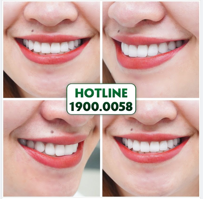 DÁN SỨ VENEER -  MỎNG - NHẸ - AN TOÀN - ĂN NHAI THOẢI MÁI