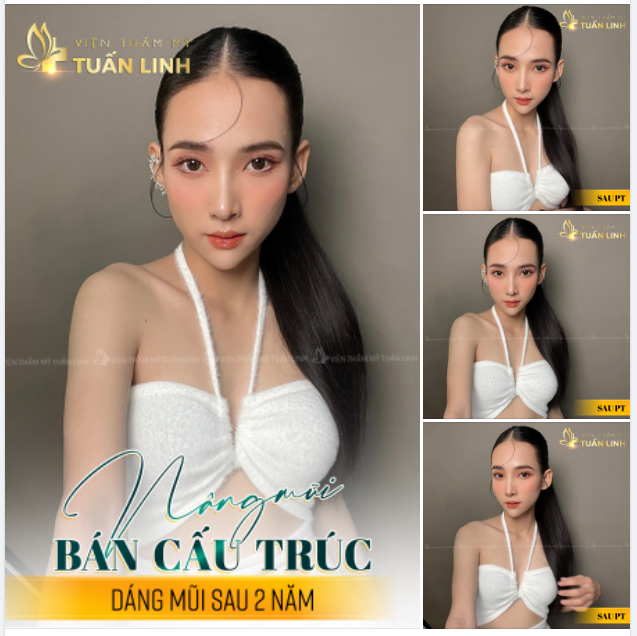 Dáng mũi Angel line thanh thoát tự nhiên - bền đẹp sau 2 năm