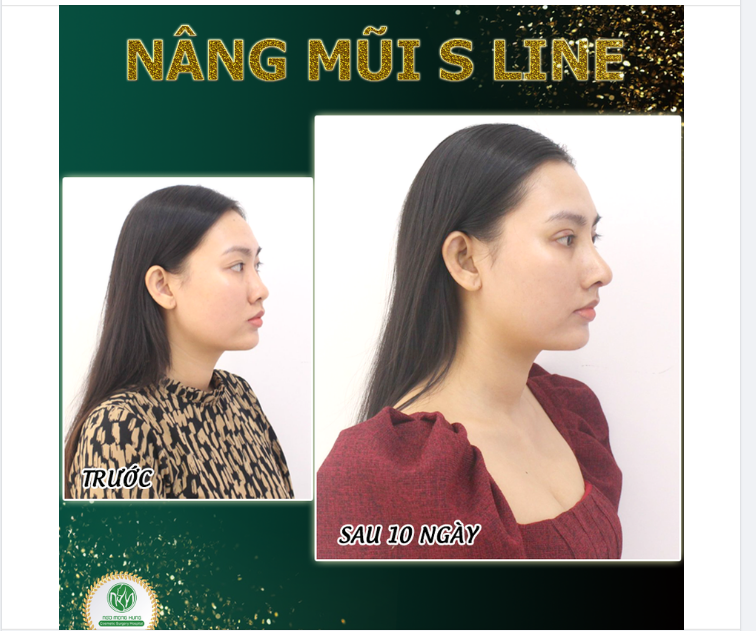 DÁNG MŨI CAO THANH THOÁT CHỈ SAU 10 NGÀY THỰC HIỆN