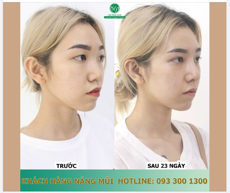 DÁNG MŨI ĐẸP - CAO - TỰ NHIÊN SAU 23 NGÀY