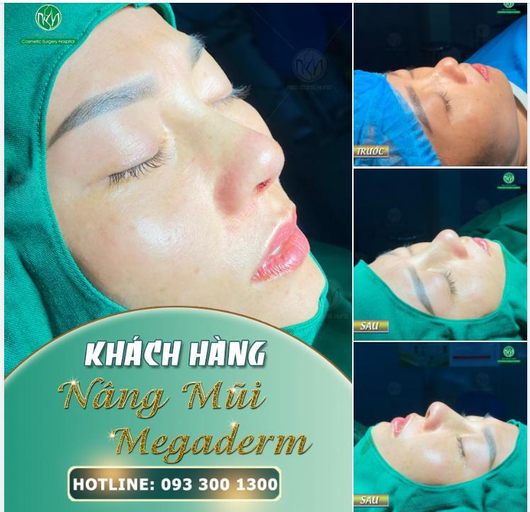 DÁNG MŨI MEGADERM HÀI HÒA TỰ NHIÊN