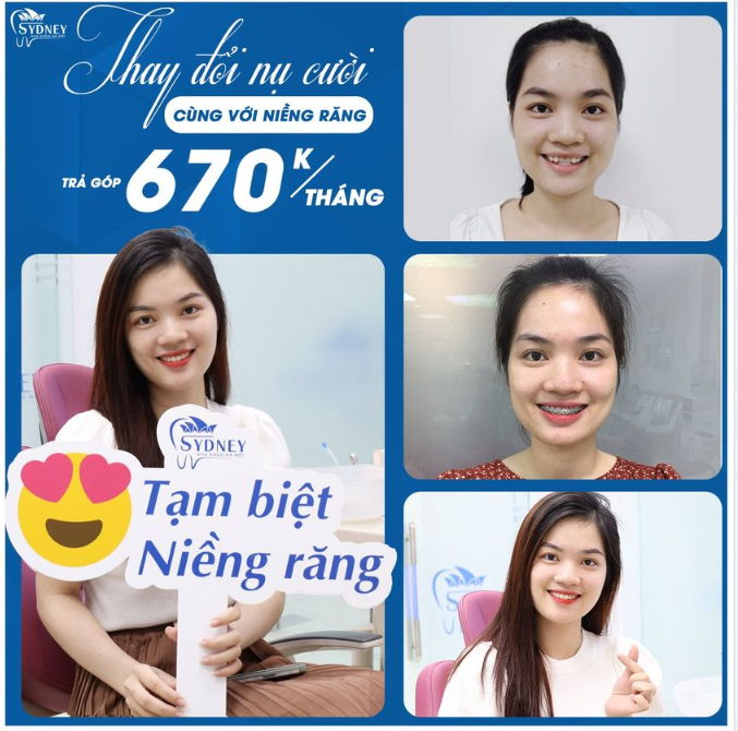 ĐÁNH BAY MÓM SAU 12 THÁNG NIỀNG RĂNG