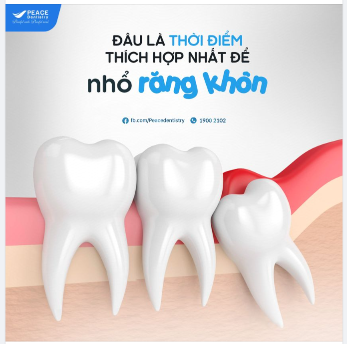ĐÂU LÀ THỜI ĐIỂM THÍCH HỢP NHẤT ĐỂ NHỔ RĂNG KHÔN?