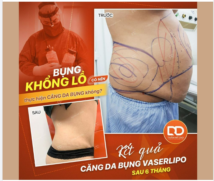 ĐÂY LÀ HÌNH ẢNH THỰC TẾ KẾT QUẢ SAU 6 THÁNG THỰC HIỆN CĂNG DA VASERLIPO CA BỤNG KHỔNG LỒ.
