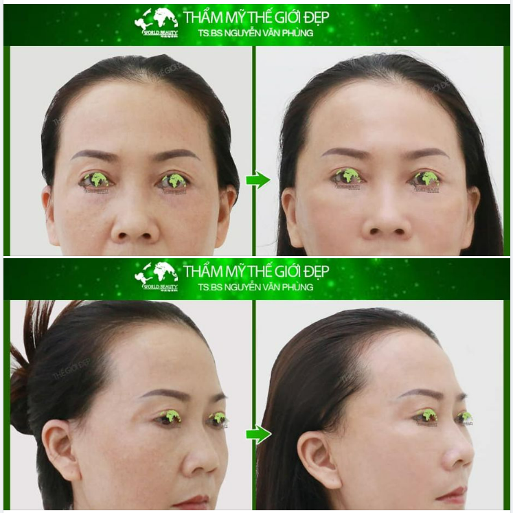Đẩy lùi lão hóa- Trẻ hơn 5 tuổi đến 10 tuổi với giải pháp căng da mặt bằng chỉ 