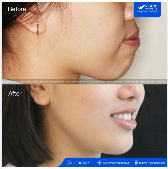 "DẬY THÌ THÀNH CÔNG" NHỜ THAY ĐỔI KHUÔN MẶT SAU KHI NIỀNG RĂNG
