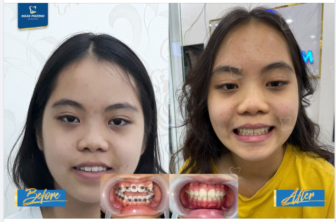 Đeo hàm duy trì - bước cuối cùng trong hành trình sở hữu hàm răng đều đẹp
