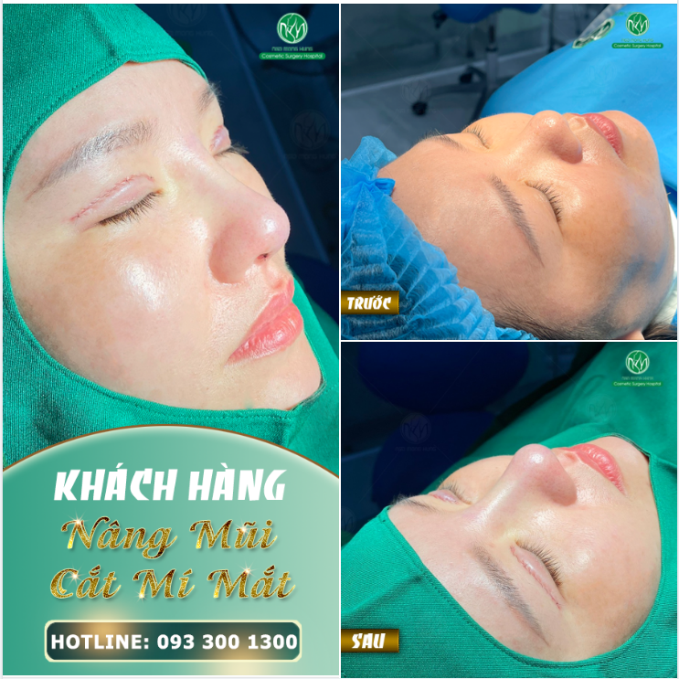 ĐẸP TOÀN DIỆN VỚI COMBO CẮT MÍ KẾT HỢP NÂNG MŨI