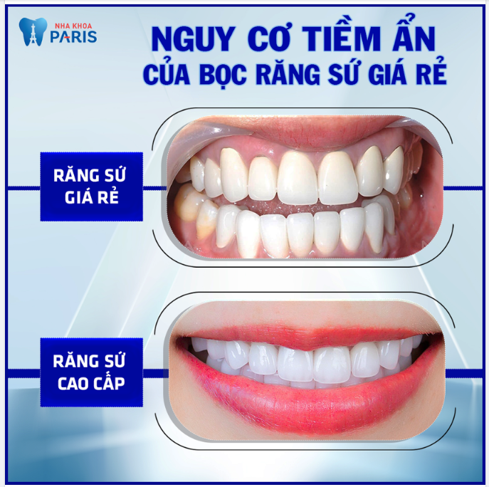 ĐIỂM KHÁC NHAU CỦA RĂNG SỨ CAO CẤP VÀ RĂNG SỨ GIÁ RẺ