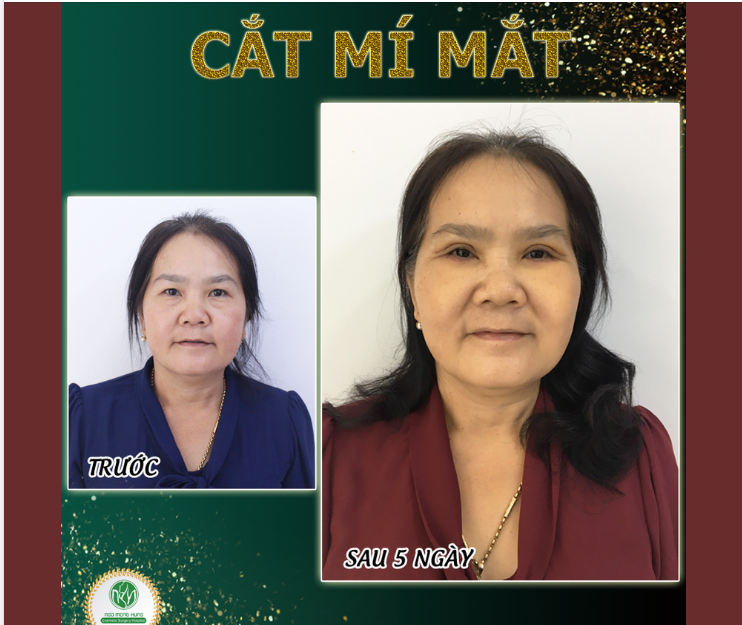 DIỆN MẠO TRẺ TRUNG HƠN SAU CẮT MÍ MẮT