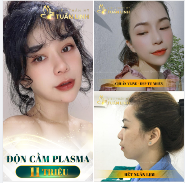 Điêu khắc dáng cằm đẹp tự nhiên, chuẩn phong thủy - Giá chỉ 11TR - Trả góp lãi suất 0%.