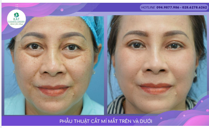 “Điều kì diệu của combo cắt mí mắt”