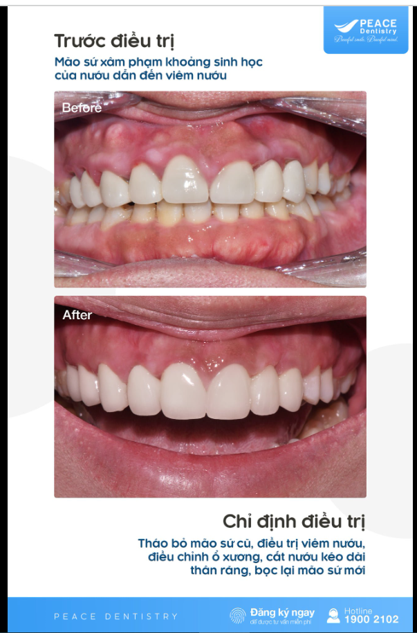 Điều trị viêm nướu, điều chỉnh ổ xương, kéo dài thân răng và bọc lại răng sứ mới