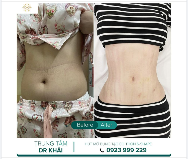 Đỗ Quang Khải TRẢ KẾT QUẢ HÚT MỠ BỤNG SIẾT EO ĐỒNG HỒ CÁT 11 NGÀY