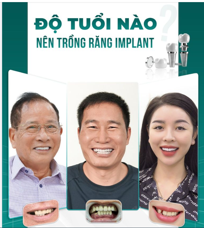 Độ tuổi nào cũng cần trồng răng Implant!